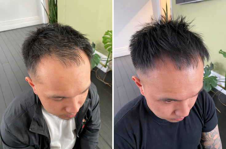 Client Results for a thinning hairline